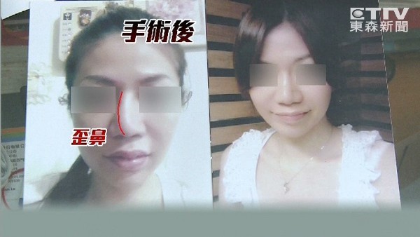 台南女子花10多万整容术后鼻子歪了 图 台湾万象 中国台湾网